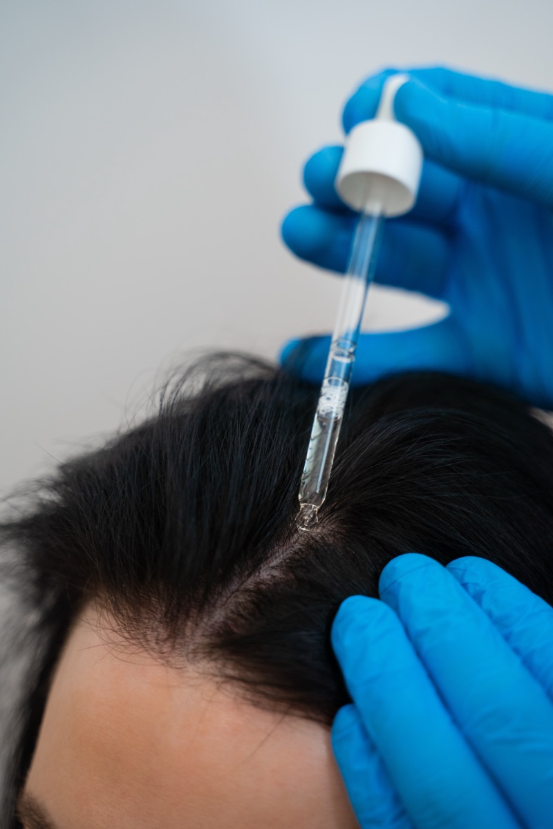 Scalp serum treatment by trichologist post mesotherapy for hair recovery.